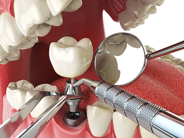 Best Emergency Wisdom Teeth Removal in Los Alamos, CA